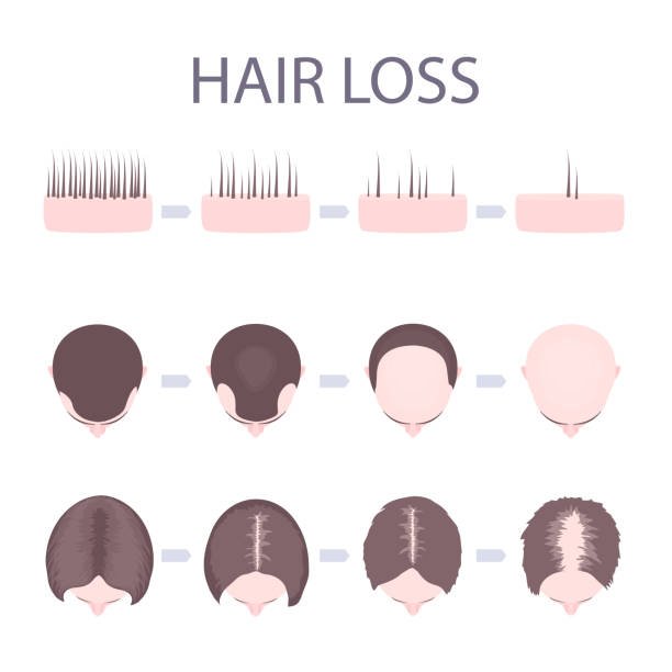 Hair Loss Transplant Treatment in London – LHTC