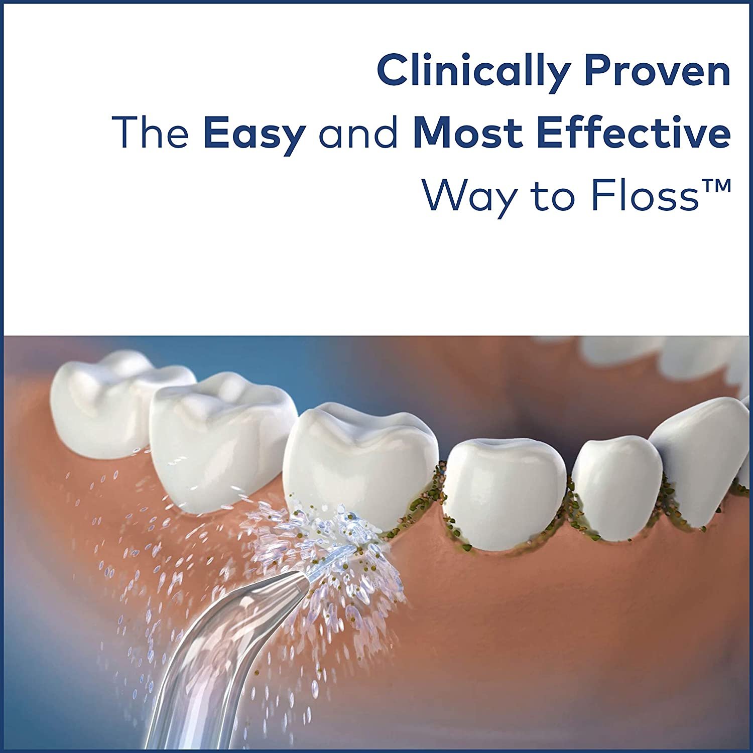 Best Way For Cleaning Teeth with Braces, Implants, veneers and crowns