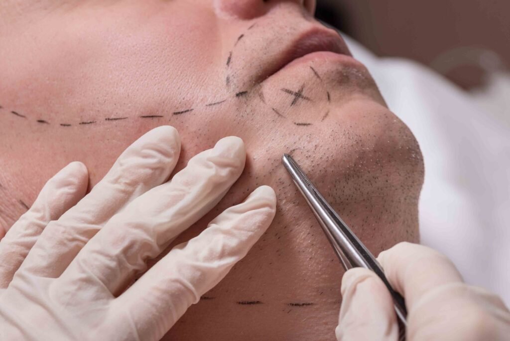 Do you need fuller facial hair yet are uncertain where to get an  FUE beard transplant in London?