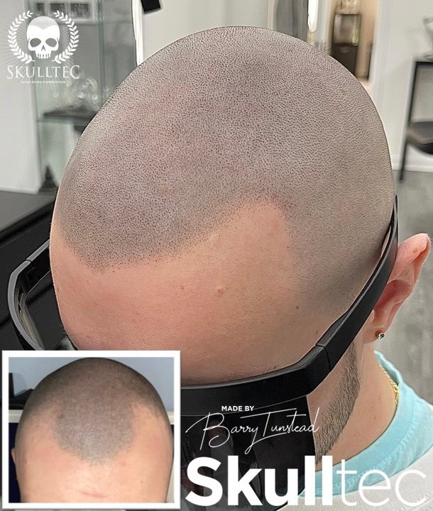 Scalp Micropigmentation in Glasgow