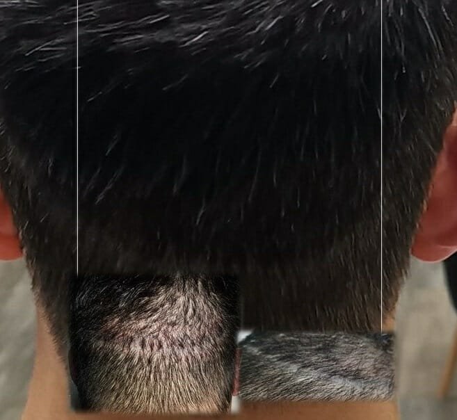 Scalp Micropigmentation For Scars (FUT & FUE)